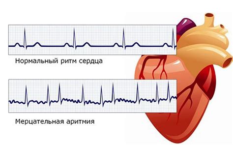 Аритмия: проблема сердца