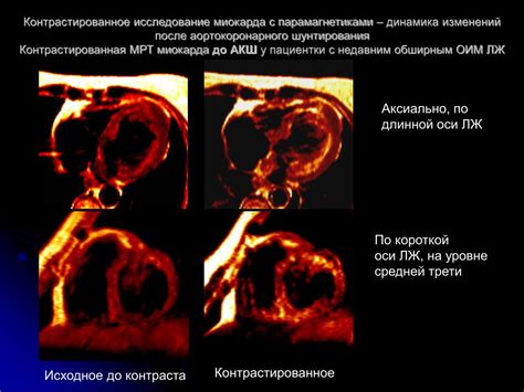 Влияние накопления парамагнетика на результаты МРТ