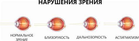 Возможные нарушения зрения
