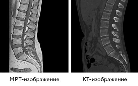 Дегенеративные изменения в позвоночнике