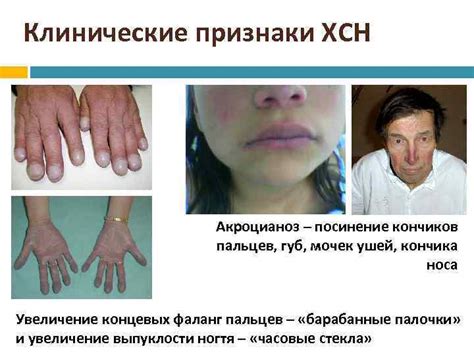 Признаки синеции кончиков пальцев