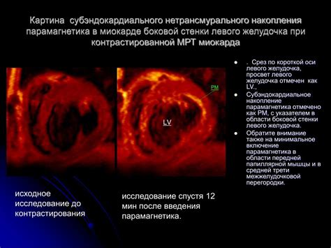 Причины накопления парамагнетика в организме