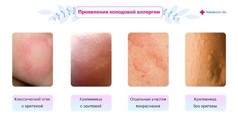 Реакция на холод